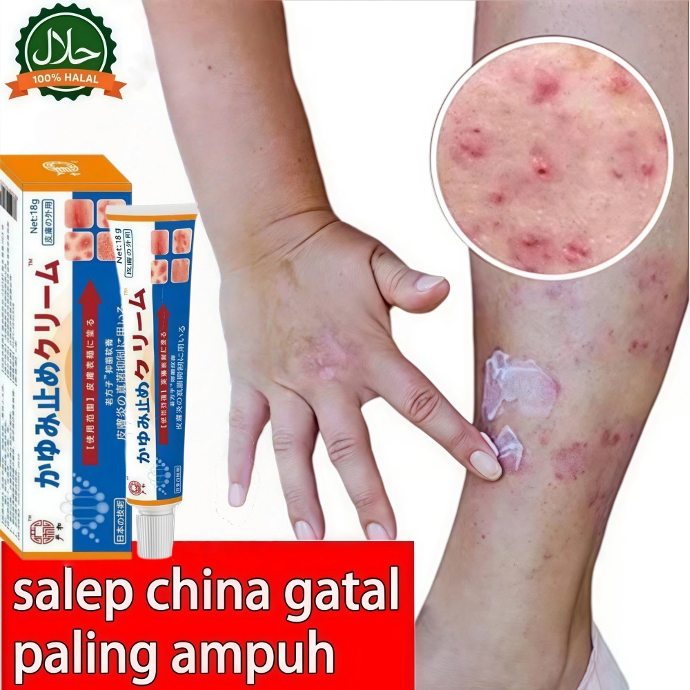 obat herpes kulit, herpes zoster, herpes genital, herpes dingin, herpes genital, salep herpes, pengh