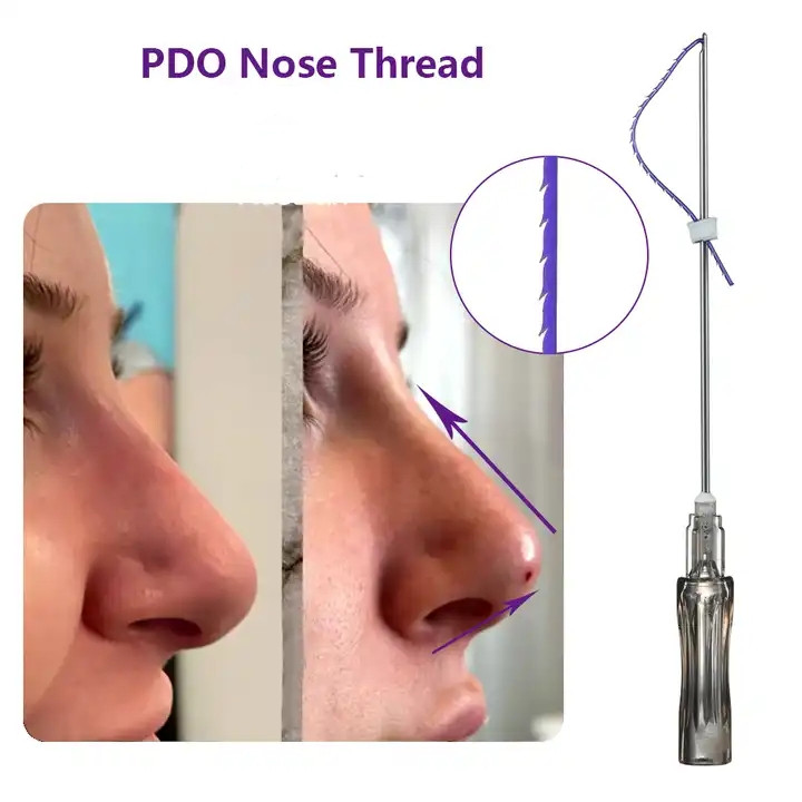 Minerva Benang Hidung Thread Lift  PDO//PCL  19g*60mm//19g*38mm//Retail//2benang