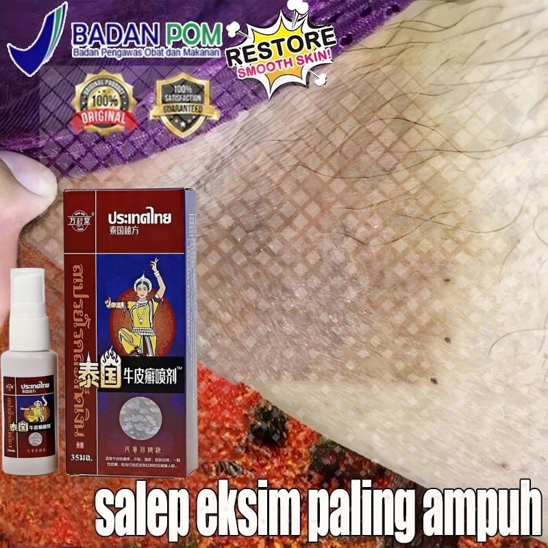Semprot psoriasis 35ML salep gatal selangkangan salep eksim kering paling ampuh paling ampuh kulit y