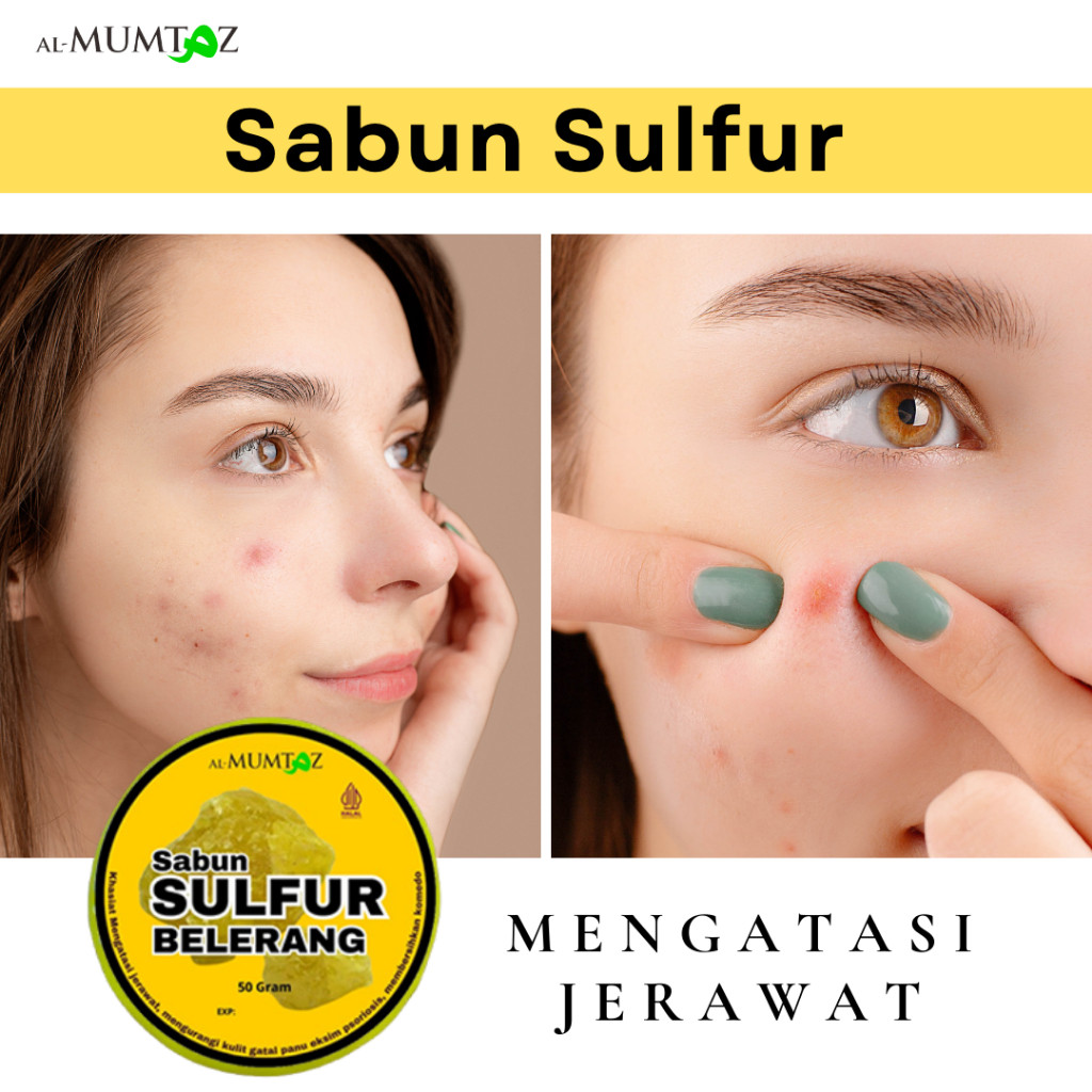 PROMO SABUN JERAWAT Sabun Sulfur Belerang untuk Gatal, Jerawat, Eksim, Scabies, Panu – Ampuh Atasi I