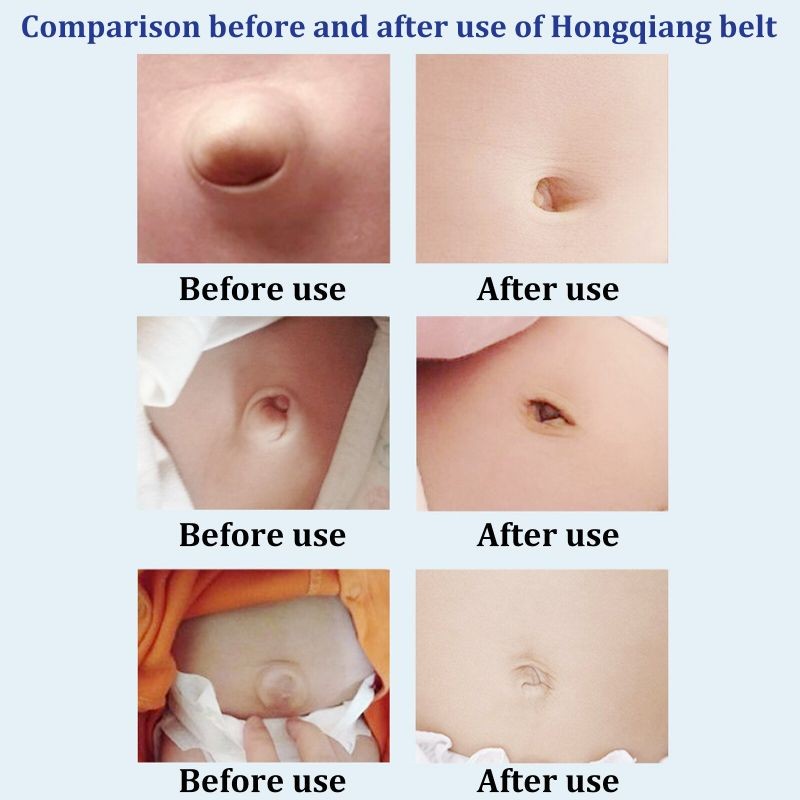 Sabuk Pusar Bayi Bodong Babys Umbilical Truss Sabuk Bayi Hernia Pusar Bodong