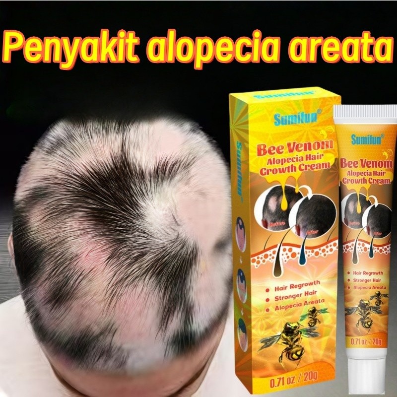 SUMIFUN Obat Alopecia Areata, Obat Penumbuh Rambut Botak, Obat Botak Koin, Obat Rambut Pitak, Obat P