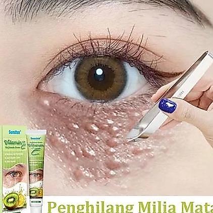 krim penghilang milia syringoma xanthelasma butiran lemak sekitar mata