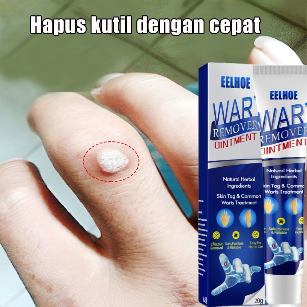 Penghilang Kutil Dan Tahi Lalat Obat Penghilang Kutil Di Wajah Papiloma Wajah Kutil Leher Penghilang