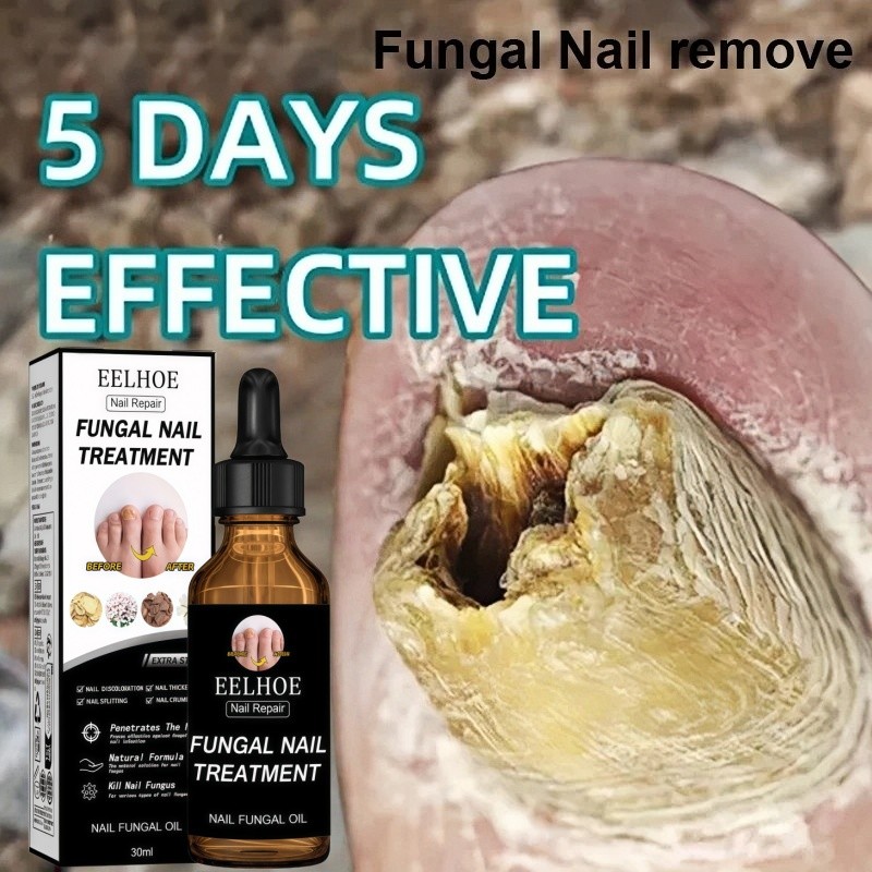 Obat jamur kuku obat kuku rusak obat kuku cantengan 30ml nail repair essence perawatan kuku Obat Can