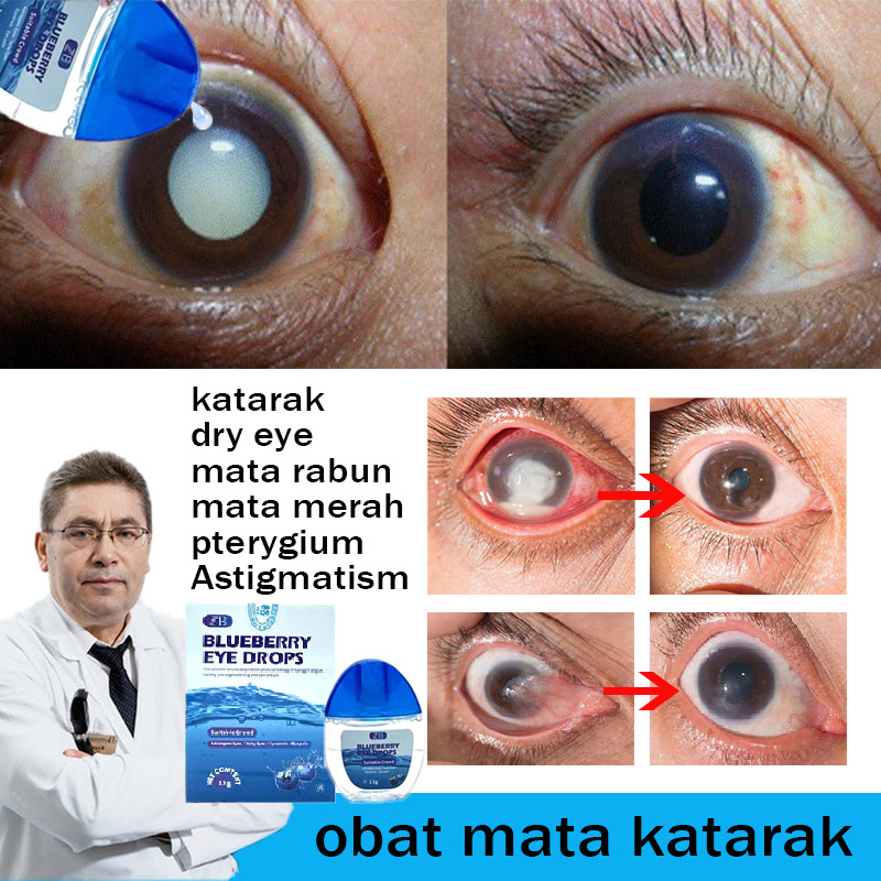 SORAYU Obat mata katarak Blueberry Eye drop Obat mata merah Pengobatan mata rabun mata buram mata ke