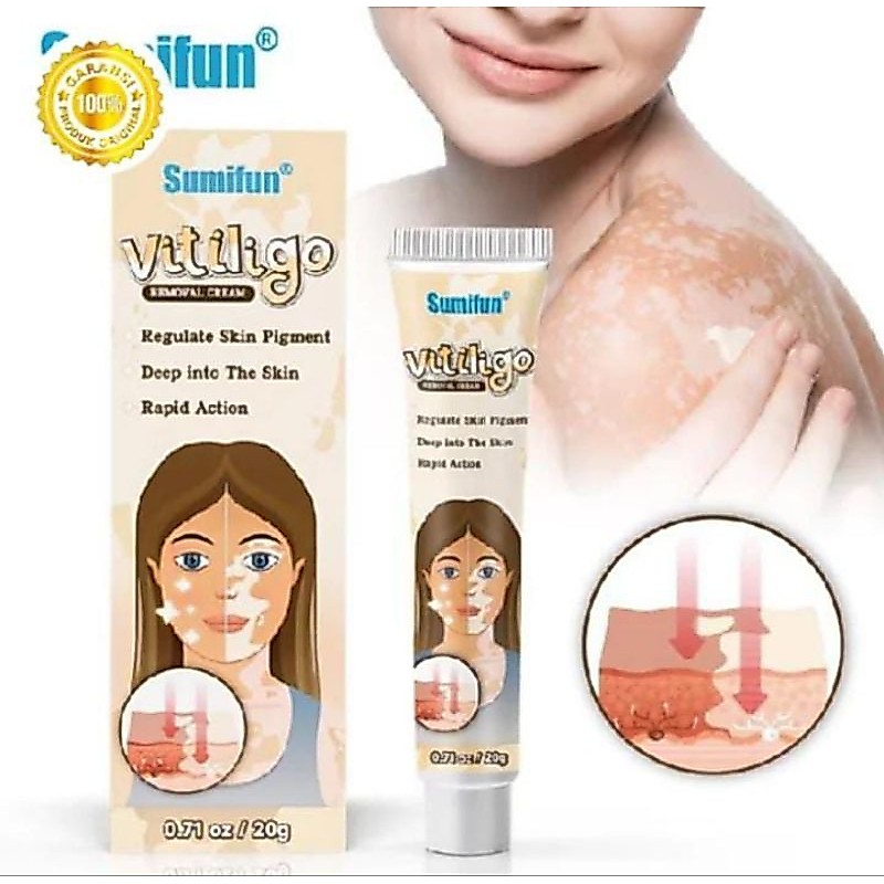 VITILIGO Cream krim penghilang vitiligo bercak putih noda putih pada kulit pigmen bintik belang mela