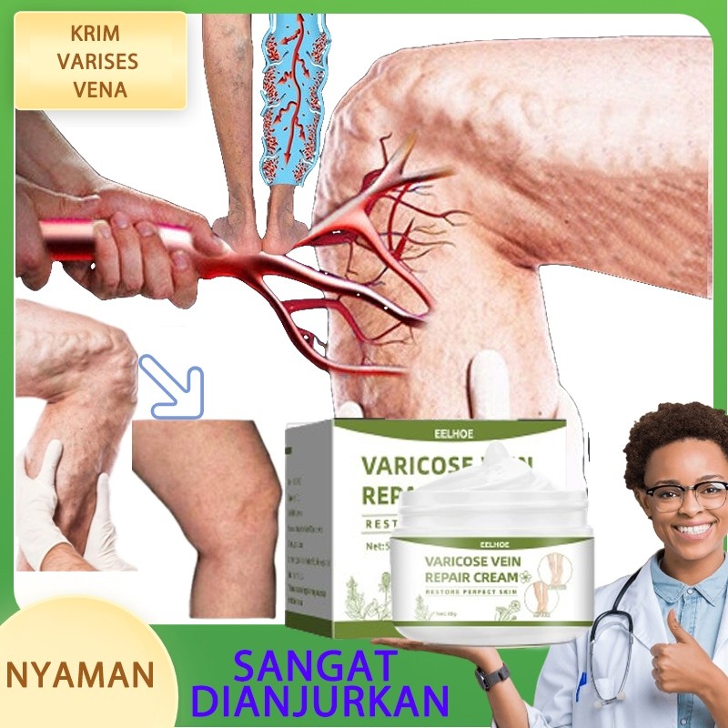 Varicose Veins Perbaikan Cream Obat Varises Salep Obat Salep Varises Yg Asli Cream Penghilang Varise