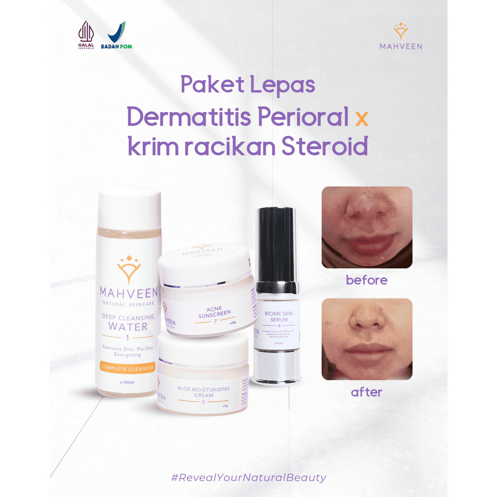 Paket Lepas Dermatitis Perioral x Krim Racikan Steroid