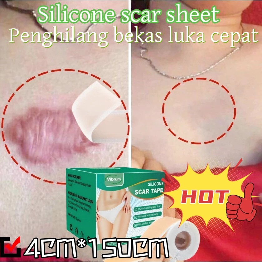 Vibrum Silicone Scar Sheet Gel  4CM*150CM silikon penghilang keloid bekas luka Plester Bekas Luka Me
