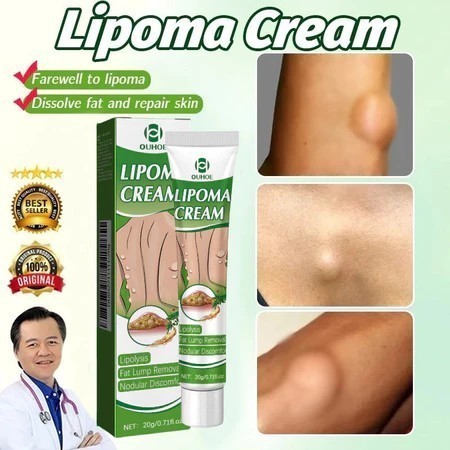 OUHOE Lipoma Cream Obat Benjolan Subkutan Lipoma Removal Cream Obat Salep Benjolan Lipoma Ampuh Herb