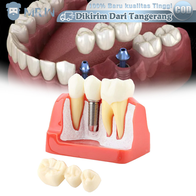 Model Implan Gigi Peraga Model Gigi Implant Crown Bridge Model Gigi Edukasi 4 Pembesaran