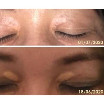 Bisa cod - Xanthelasma Cream 10gr Cream Penghilang Lemak Mata Cream Bruntusan Pada MataMurah