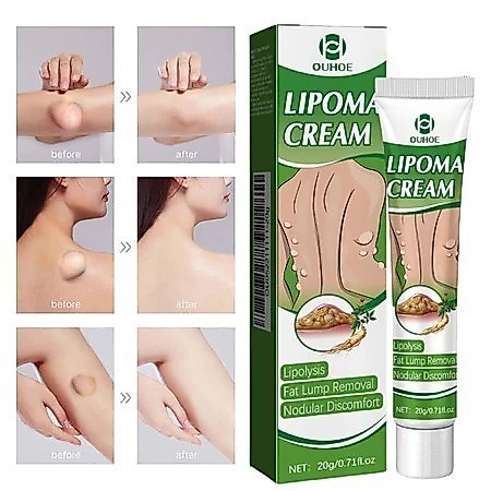 OUHOE Lipoma Cream Obat Benjolan Subkutan Lipoma Removal Cream Obat Salep Benjolan Lipoma Ampuh Herb