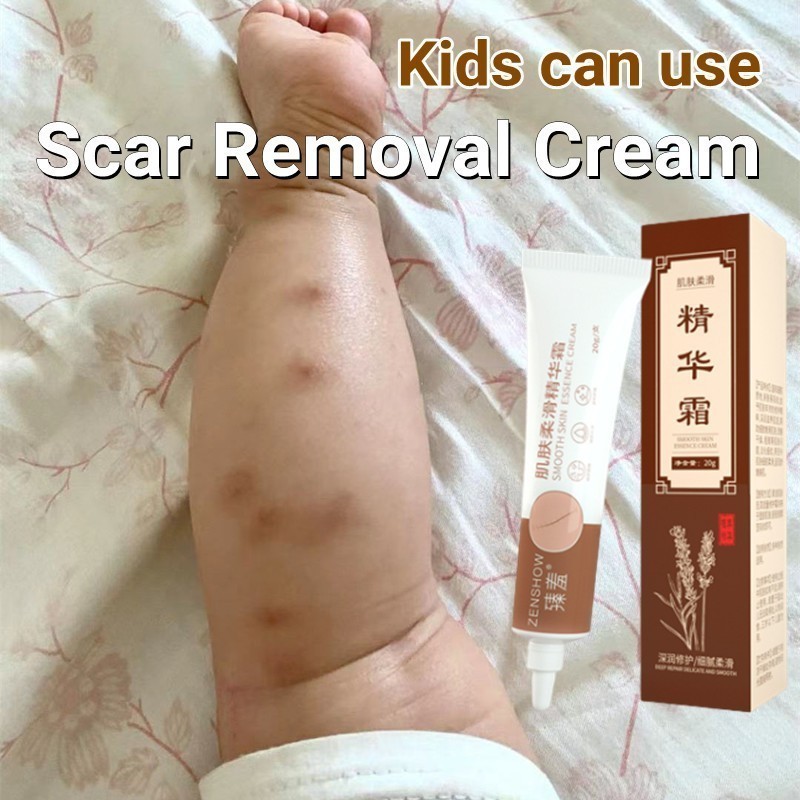 COD Penghilang Bekas Luka Bayi Anak Krim Kaki Hitam Koreng Menghilangkan Bekas Luka Wajah Penghilang