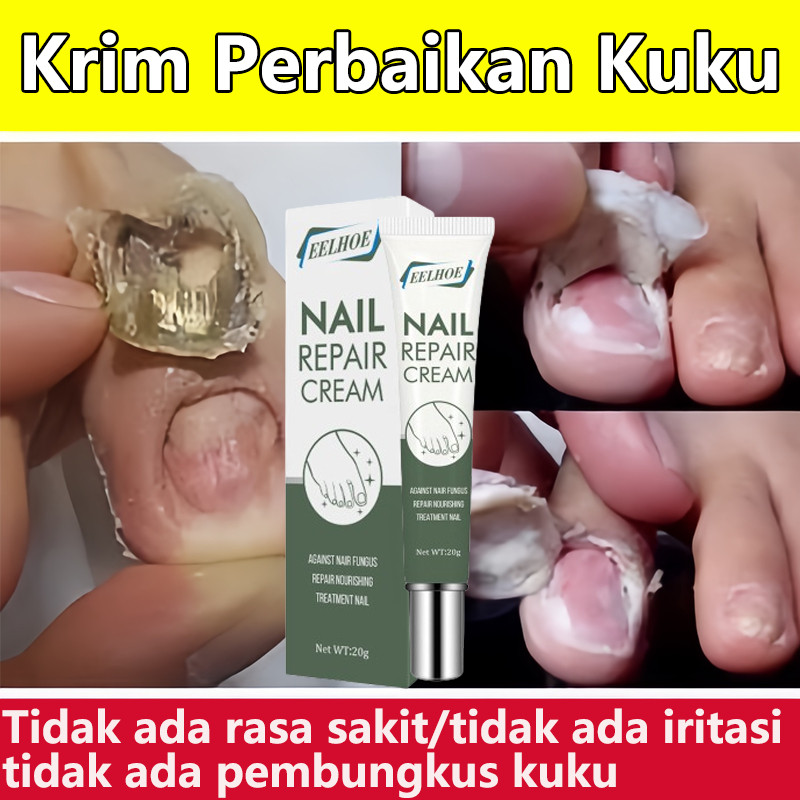 Obat Kuku Penghilang Jamur Obat Kuku Rusak Obat Kuku Jamur 20g Obat Kuku Jamur Dan Rusak Perawatan K