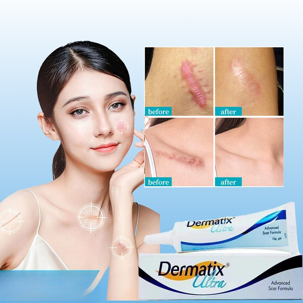 COD dermatix ultra original 100% Dermatik Ultra /Gel Perbaikan Bekas Luka Jerawat Dermatic Krim Peng