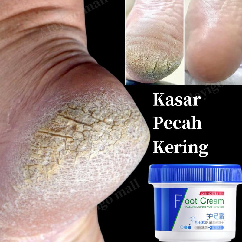 Cream kaki pecah dan kering ampuh Perawatan kaki