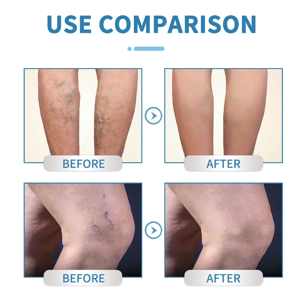 South Moon Varicose Veins Spray 30ml Obat Varises Salep Penghilang Varises Di Kaki Varises Semprot