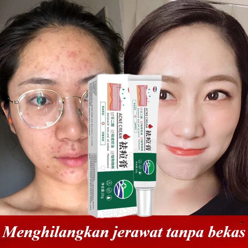 COD CINSULIN Obat Jerawat Batu Bruntusan BPOM Original Salep Jerawat Herbal Acne Spot Treatment Toto