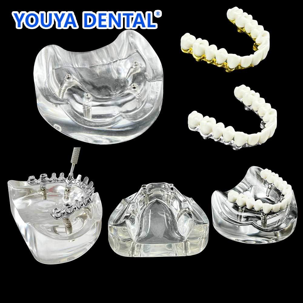 Model Restorasi Implan Gigi dengan 4 Implan untuk Rahang Atas, untuk Pendidikan dan Pengajaran Mahas