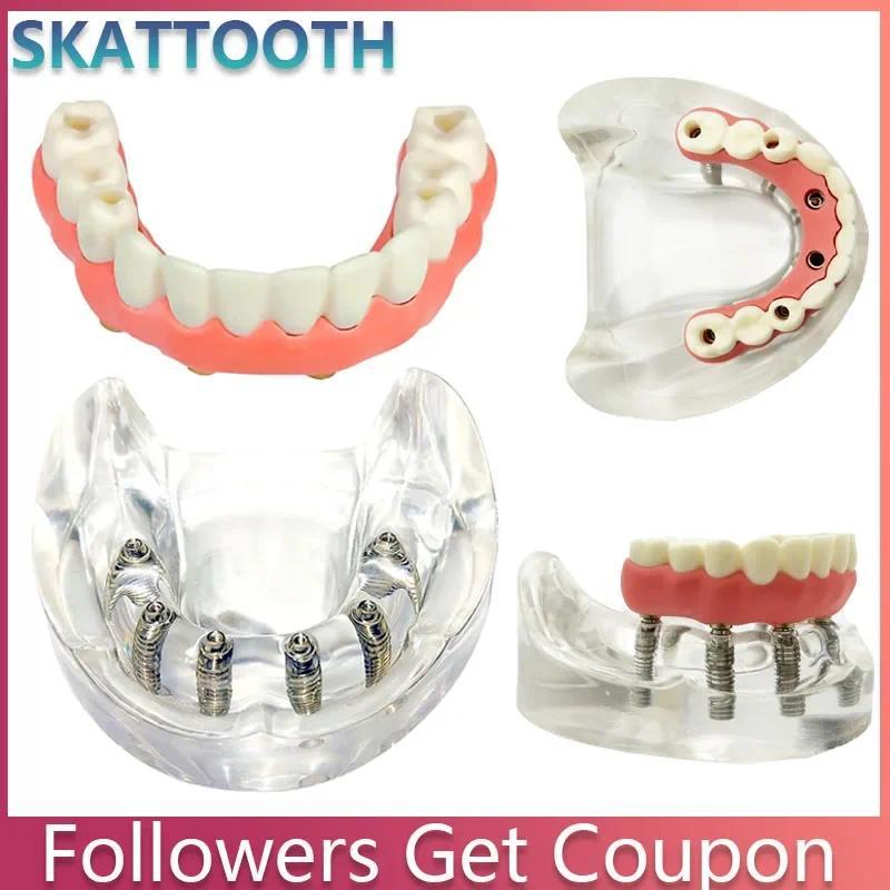 Model Implan Gigi Bawah untuk Overdenture, Model Implan yang Dapat Dilepas untuk Penelitian, Pengaja