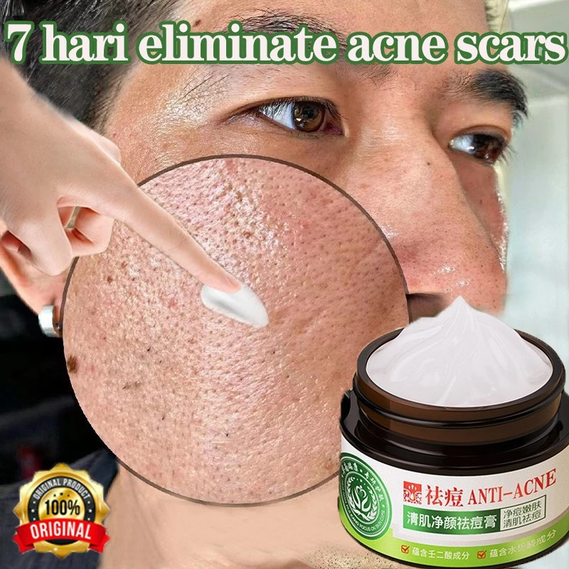 Krim Penghilang Bekas Jerawat - Obat Lubang Jerawat & Penghilang Bopeng, Krim Wajah Penghilang Flek 