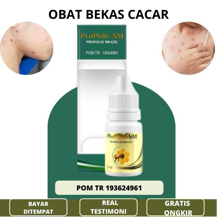 Penghilang Bekas Cacar, Penghilang Bekas Cacar Air,  Bekas Cacar Lama,  Bekas Luka Cacar Dengan ProP