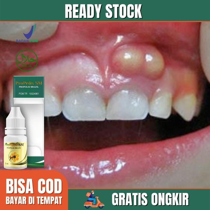 Obat Gigi Gusi Abses, Gusi Sakit Bengkak Ngilu, Sakit Gigi-Propolis SM
