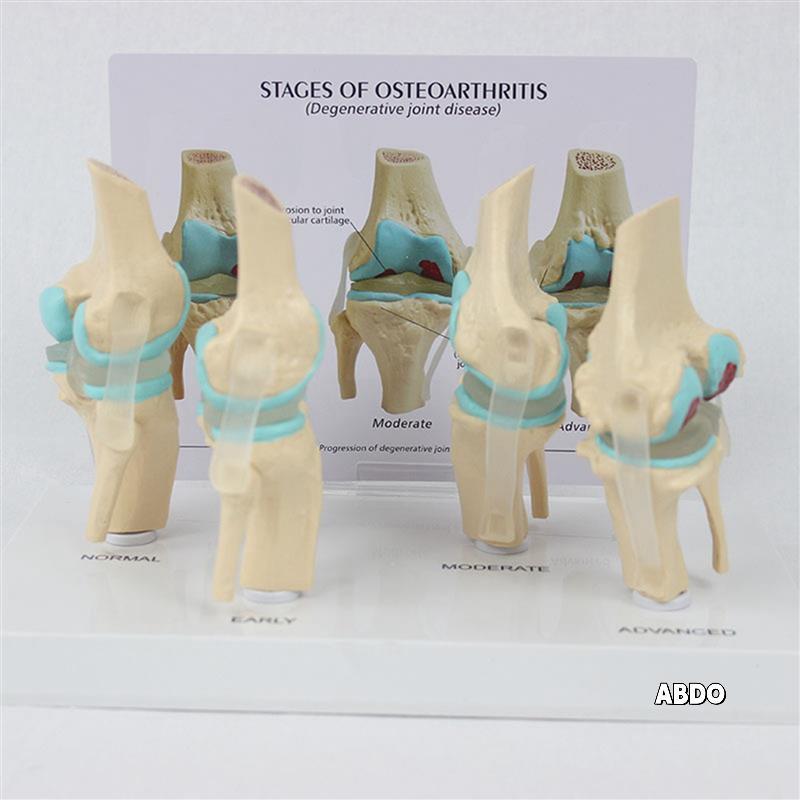 2X Knee Kit Osteoarthritis Anatomy Model With Educational Key Card 4 Stage Knee Model Orthopec Teain