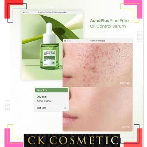 YOU AcnePlus series serum acne