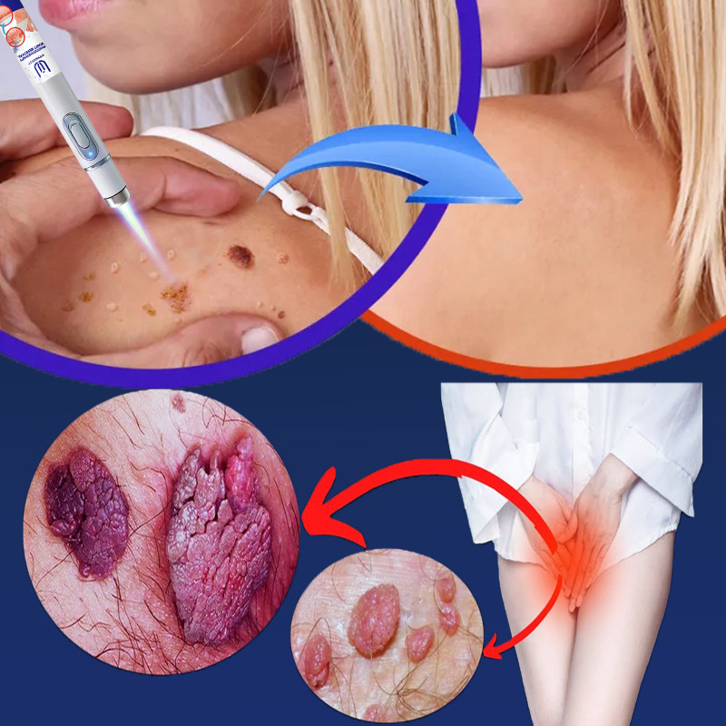 Intense laser therapy can treat