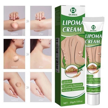 OUHOE Lipoma Cream 20g Obat Benjolan Subkutan Lipoma Removal Cream Obat Salep Benjolan Lipoma Ampuh 