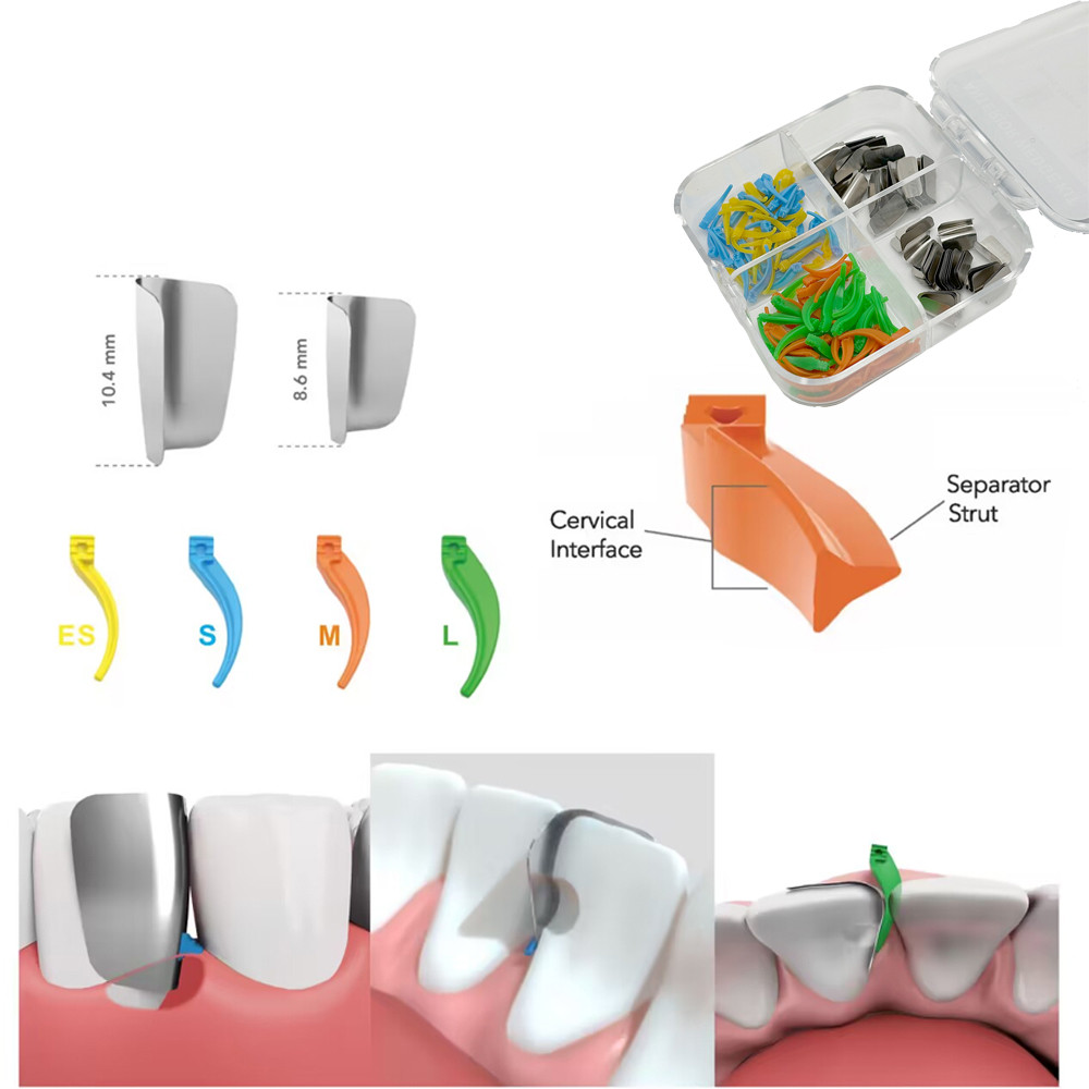 200Pcs/box Sistem Matriks Anterior Gigi, Pita Matriks Wedge, Wedge Interdental, Perlengkapan Kedokte