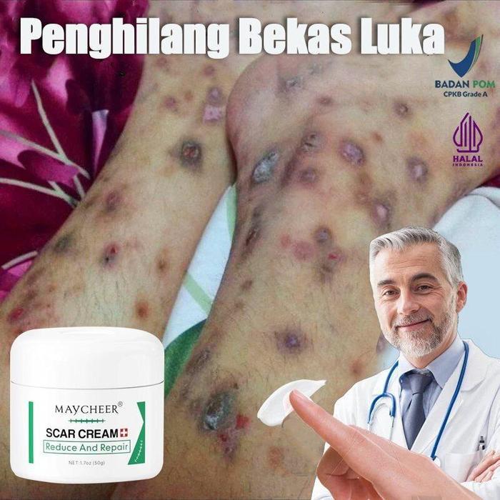 Penghilang bekas luka hitam koreng Penghilang bekas luka di kaki Penghilang Bekas cacar Bekas gigita