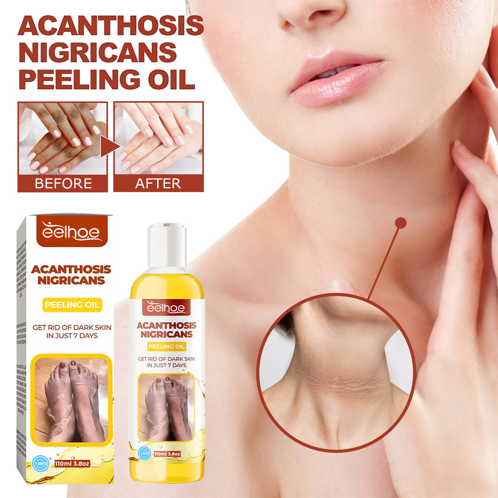 EELHOE Acanthosis Nigricans Peeling Badan Pengelupasan Minyak 50ml Pengelupasan Kulit Badan Moist Me