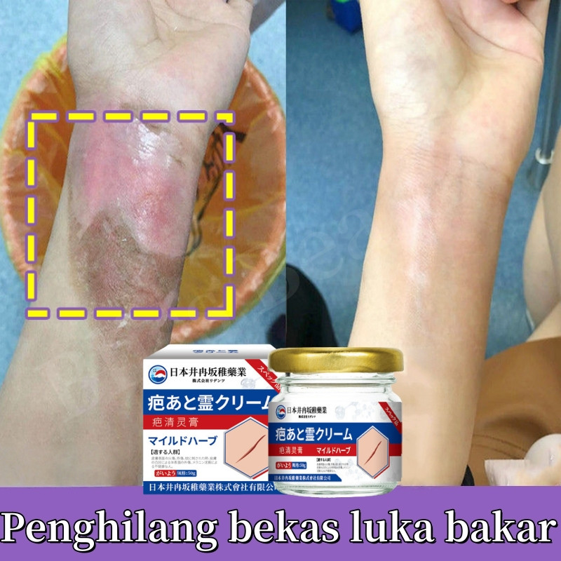 Krim Penghilang Bekas Luka Bekas Hitam Koreng Keloid, Luka Bakar Bekas Lama Untuk Kaki Tubuh
