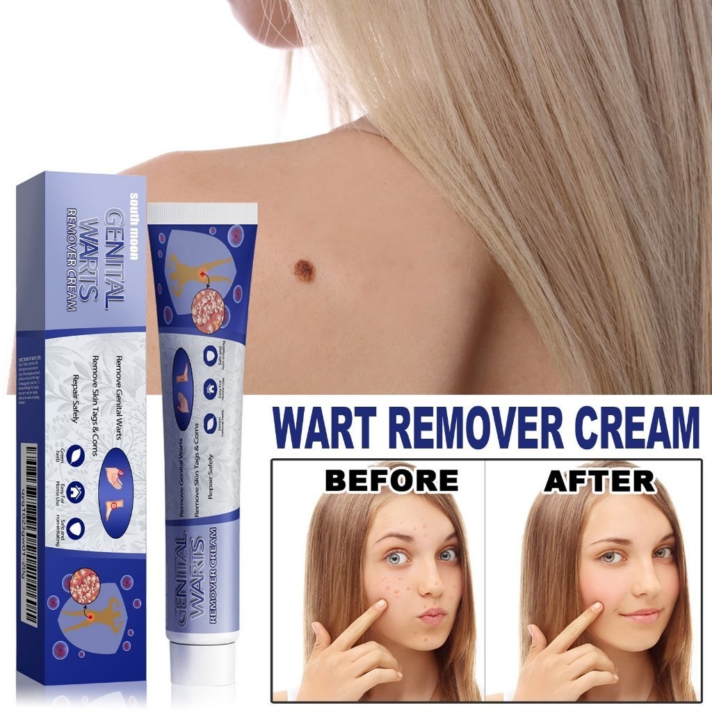 South Moon Penghilang Kutil Dan Tahi Lalat 1pcs Penghilang Tahi Lalat Di Wajah Kutil Penghilang Tahi