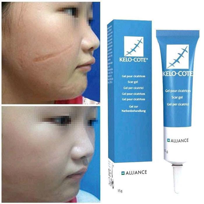 Kelocote pengilang bekas luka oprasi keloid