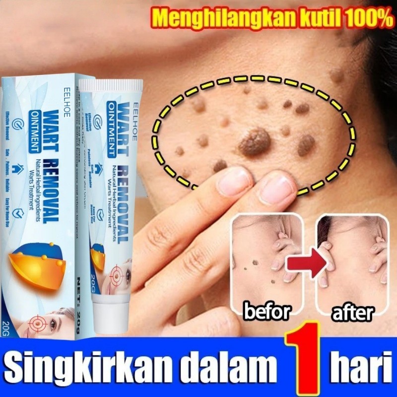 EELHOE 100% Asli Penghilang Tahi Lalat Penghilang Kutil Skin Tag Remover Obat Kutil Di Leher Penghil