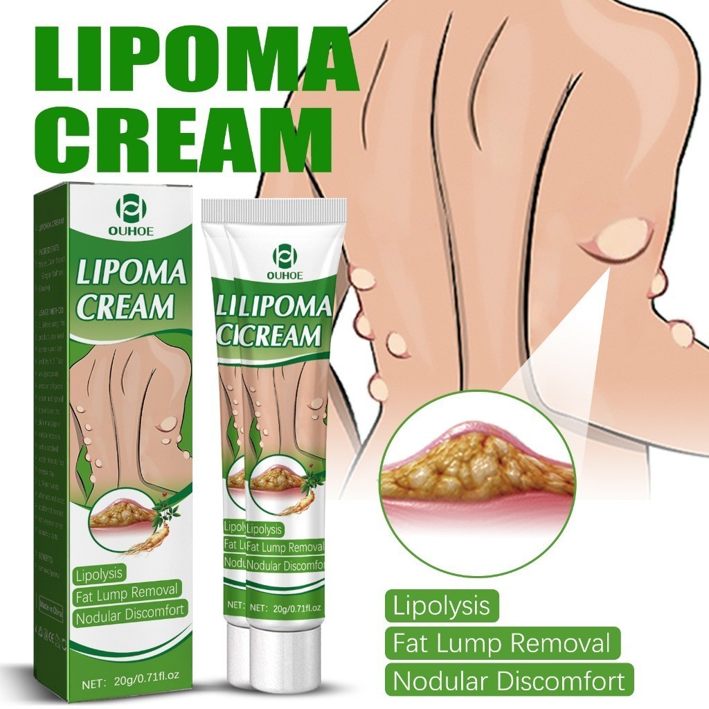 OUHOE Lymph Cream 20g Perawatan Tubuh Lipoma Cream Obat Benjolan Lipoma Krim Benjolan Di Leher Tanga