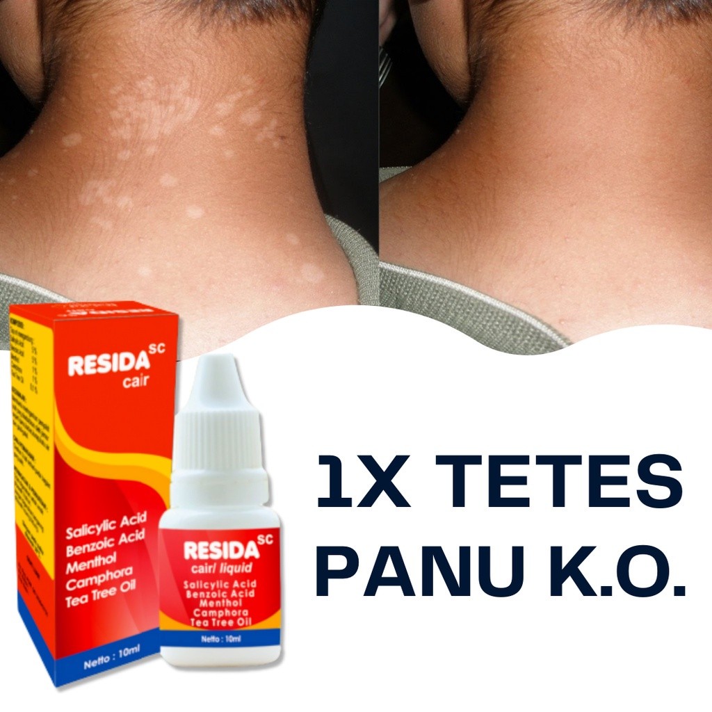 Obat Panu Cair Paling Ampuh 100% Obat Panu Cair Resida Original BPOM Penghilang Gatal Jamur Kadas Ku
