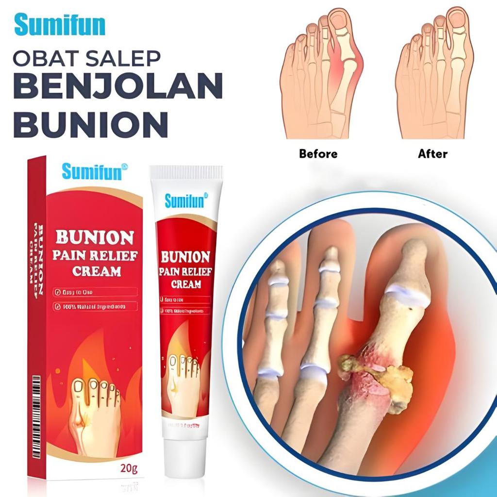 Sumifun Bunion Pain Relief Cream – Salep Pereda Nyeri Bunion & Pegal Sendi 20g