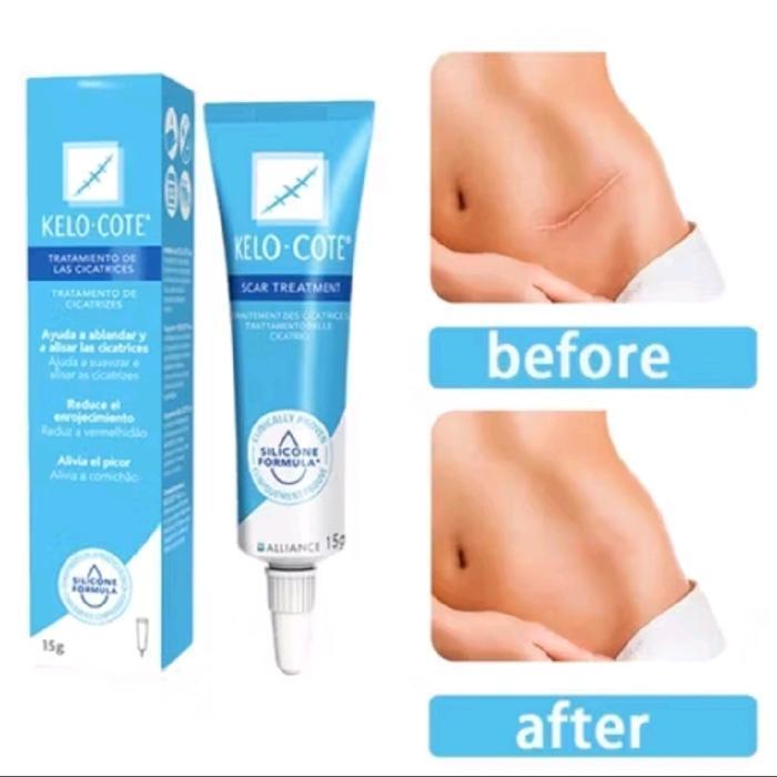 KELO COTE - KELOCOTE GEL ASLI PENGHILANG BEKAS LUKA OPERASI