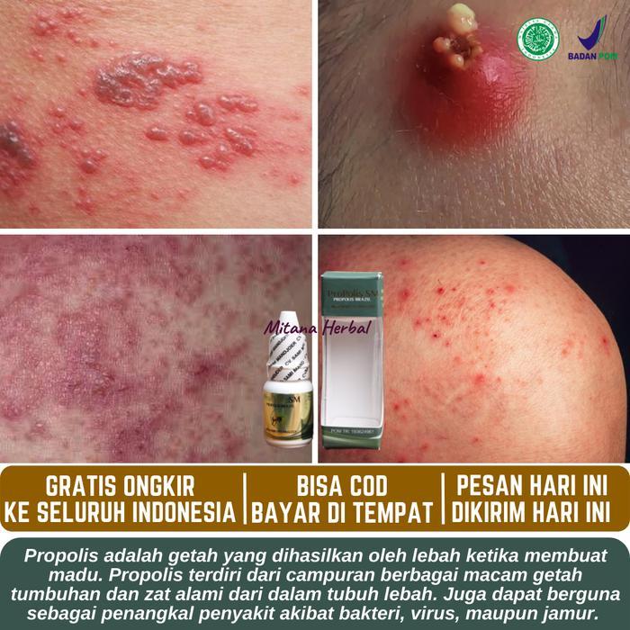 Obat Penghilang Gatal Bruntusan, Bisul Di Pantat, Bekas Luka Hitam