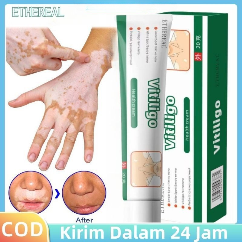 Salep Pengobatan Vitiligo 20g Formula Herbal Alami Menghaluskan Dan Melembabkan Area Kulit Bintik Pu