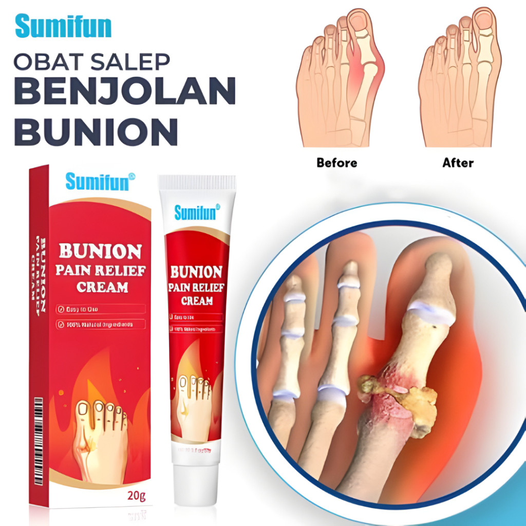 Sumifun Bunion Pain Relief Cream – Salep Pereda Nyeri Bunion & Pegal Sendi 20g