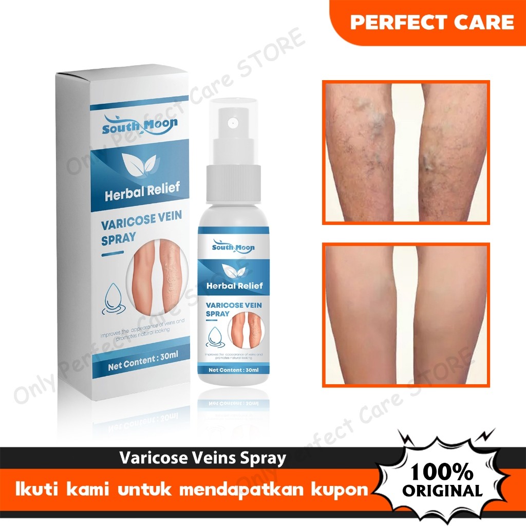 South Moon Varicose Veins Spray 30ml Obat Varises Salep Penghilang Varises Di Kaki Varises Semprot