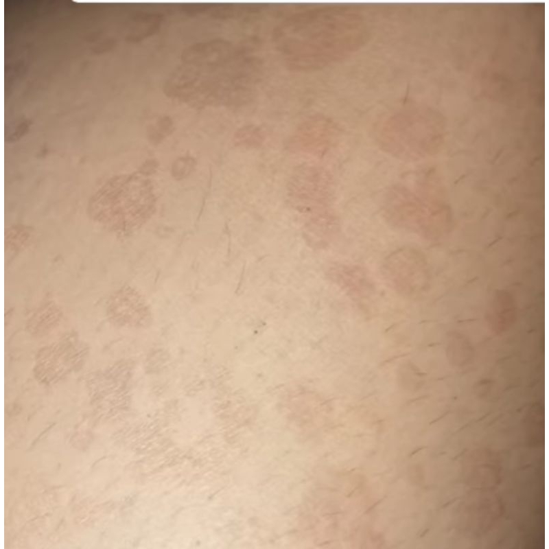 SALEP MENGHILANGKAN PANU EKSIM DAN JAMUR AMPUH