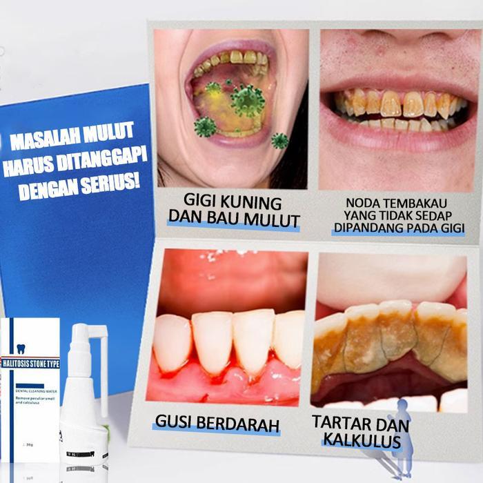 PEMBERSIH KARANG GIGI PERONTOK KARANG GIGI PALING AMPUH PENGHILANG KARANG GIGI PEMBERSIH GIGI KUNING
